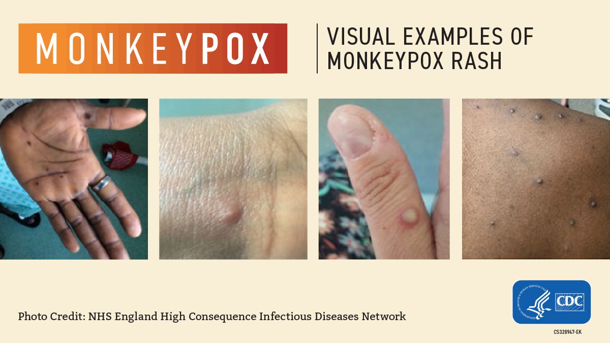 Health authority warns of uptick in cases of mpox, formerly known as  monkeypox – Oregon Capital Chronicle